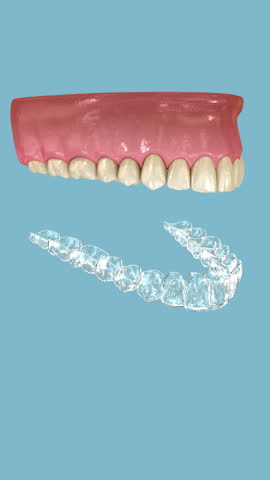 Teeth whitening with Invisalign braces or invisible retainer. 3D animation 