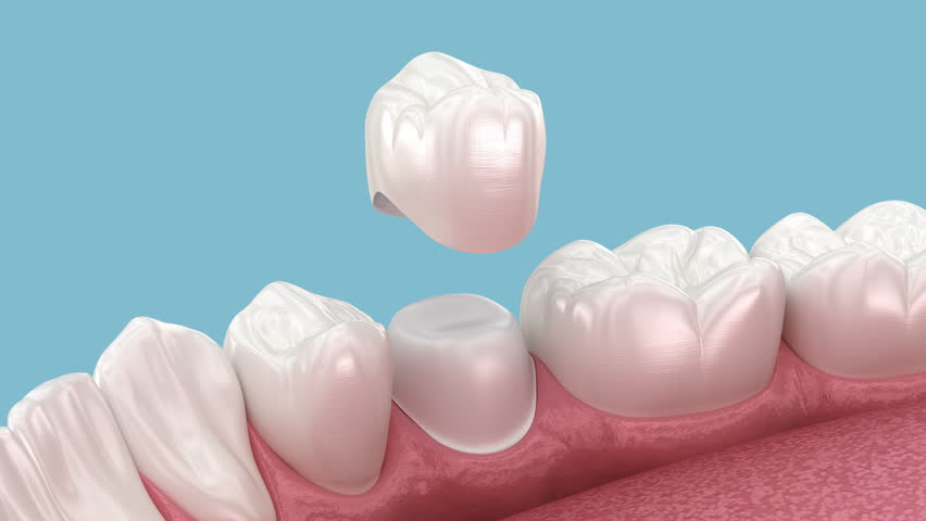 Dental ceramic crown placement. Dental 3D animation