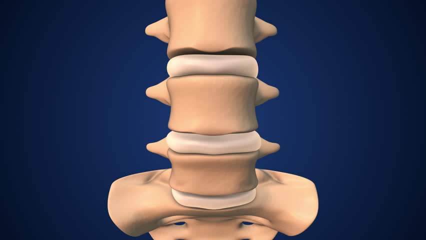 Spondylolisthesis Involving Vertebrae Shifting Out of Place