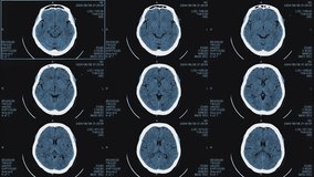 Magnetic resonance images of the brain, MRI of the brain, of a patient with multiple vascular infarctions, front view, monochrome animation Seamless Loop.  - Powered by Shutterstock - Get 15% off with code: PIKWIZARD15