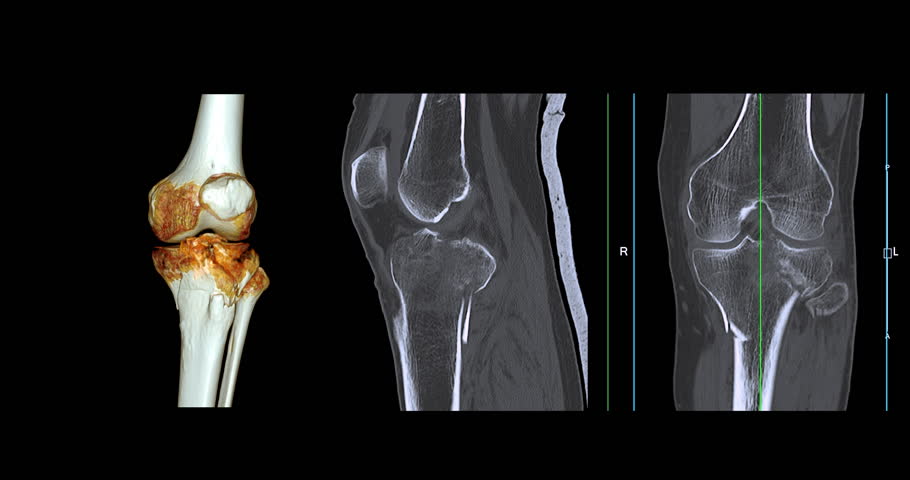 Knee Joint CT-Scan Revealing Tibial Fracture:The scan highlights a distinct fracture in the tibia, located beneath the knee joint. The break is visible as a crack.