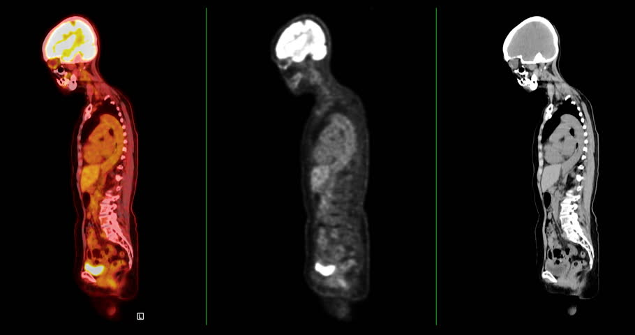 A PET-CT scan is a diagnostic imaging technique combining positron emission tomography (PET) and computed tomography (CT) in cancer diagnosis and staging. 