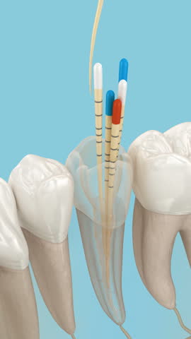 Endodontic root canal treatment process. Medically accurate tooth 3D animation