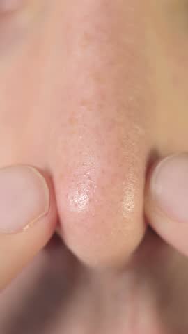 Cleaning skin on nose from pimples and black spots, close up, vertical footage.