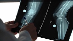 Caucasian doctor in a white coat. X-ray of the leg. X-ray of the knee. Studying the X-ray. Slow motion. High-quality shooting in 4k format - Powered by Shutterstock - Get 15% off with code: PIKWIZARD15