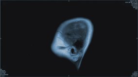Magnetic resonance images of the brain, MRI of the brain, of a patient with multiple vascular infarctions, side view, monochrome animation Seamless Loop - Powered by Shutterstock - Get 15% off with code: PIKWIZARD15