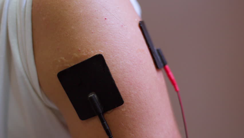 Close-up of an arm with adhesive electrodes attached, used in physical therapy or muscle stimulation. Concept of medical treatment, rehabilitation, or physical therapy session