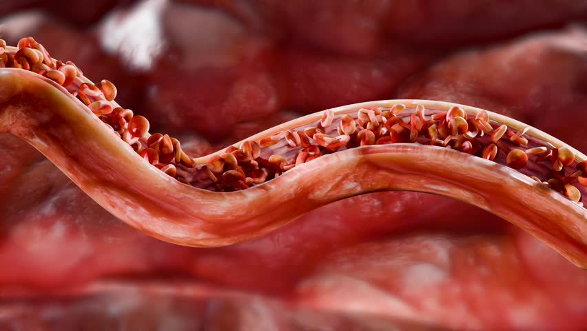 Cholesterrol or Atherosclerotic Plaque in blood vessels, Blocked vessel stroke, Thickened Arteries and Veins, Coronary, fat buildup clogging, Atherosclerosis or atheromatous Hyperlipidemia, 3d render