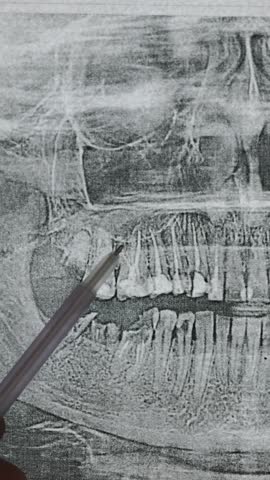 Vertical footage of Doctor examining Panoramic dental X-Ray of teeth. Diseased teeth with dental fillings, crowns, sealants.