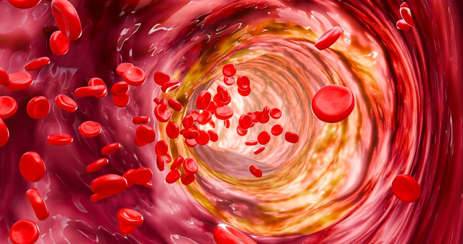 Artery clogged by unhealthy junk food, sugary drinks, and alcohol, illustrating serious cardiovascular risks, atherosclerosis, and heart disease problems in human blood vessels. 3D rendering.

