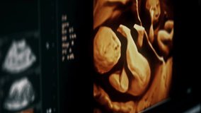 Motherhood Medical X-Ray Scan Identifying Twin Babies In Womb. Motherhood Health Check. Medical Scan Examines Children During Pregnancy. Motherhood Healthcare. Medical Scanner For Prenatal Analysis - Powered by Shutterstock - Get 15% off with code: PIKWIZARD15