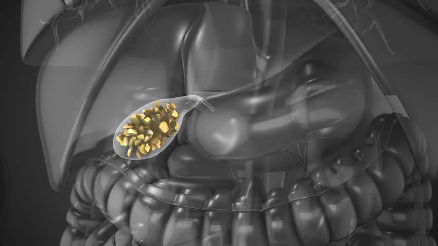 Gallstones Lodged in Gallbladder or Biliary Ducts