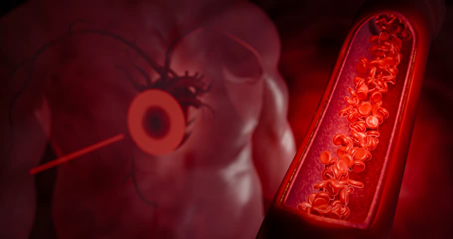 Artery clogged by unhealthy junk food, sugary drinks, and alcohol, illustrating serious cardiovascular risks, atherosclerosis, and heart disease problems in human blood vessels. 3D rendering.
