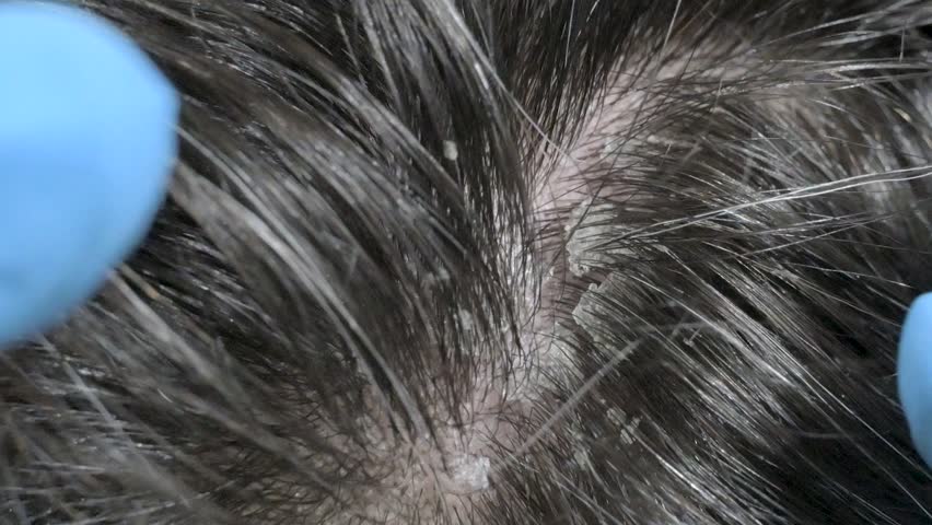 Detailed close-up image of a scalp showing dandruff being examined by gloved hands. Highlights hair health and scalp issues