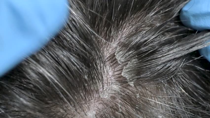 Detailed close-up image of a scalp showing dandruff being examined by gloved hands. Highlights hair health and scalp issues
