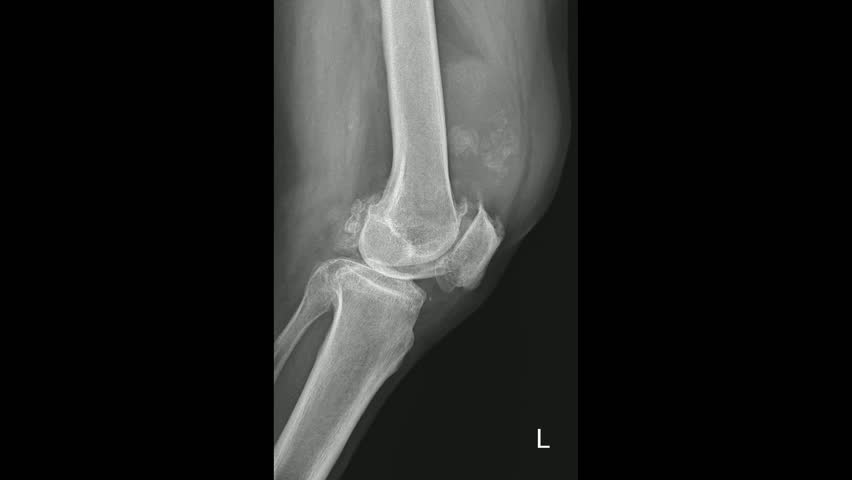 Knee Lateral X-Ray for Arthritis Diagnosis and Fractures