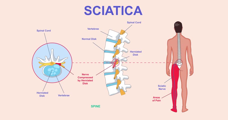 Infograhics with sciatica. Moving banner with mans spine. Healthcare and medicine. Orthopedics and correct posture. Anatomy and biology. Medical educational materials. Cartoon flat animated graphics
