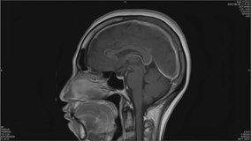 Magnetic resonance images of the brain, MRI of the brain, of a patient with multiple vascular infarctions, side view, animation Seamless Loop - Powered by Shutterstock - Get 15% off with code: PIKWIZARD15