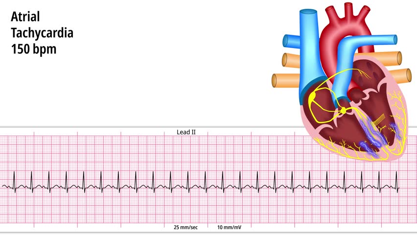 Atrial Tachycardia 150 bpm - Supraventricular - SVT - ECG and Heart Conduction - Electrocardiogram Medical Animation