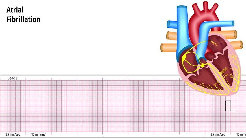 Atrial Fibrillation - ECG and Heart Conduction - Electrocardiogram Medical Animation