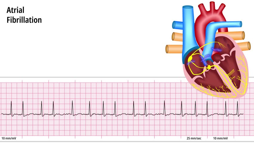 Atrial Fibrillation - ECG and Heart Conduction - Electrocardiogram Medical Animation