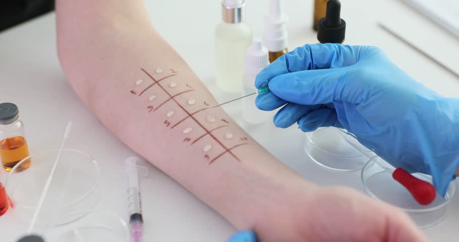 Skin allergy testing procedure in the clinic. Skin testing for patient allergens