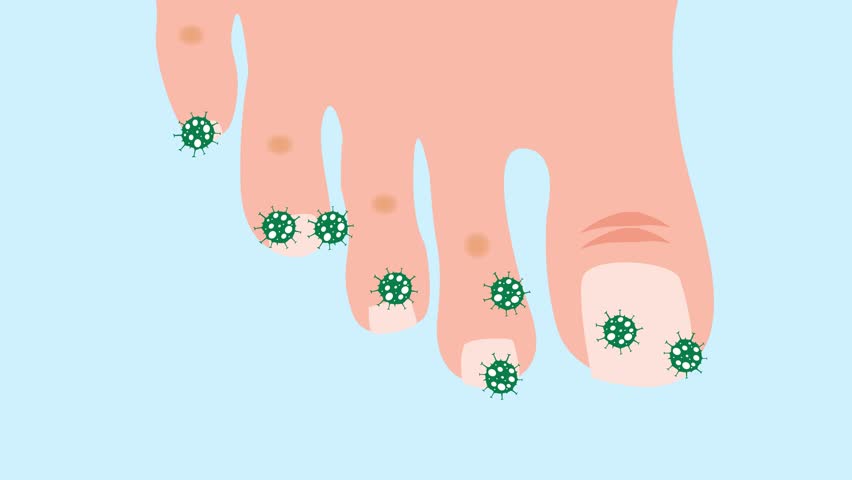 Closeup Of A Foot With Arthritis, Nail Fungus And Athlete's Foot