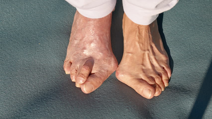 Two feet side by side with hallux valgus problem emphasizing the stark contrast in their appearance and texture, illustrating a specific foot condition and its effects bunion on daily life