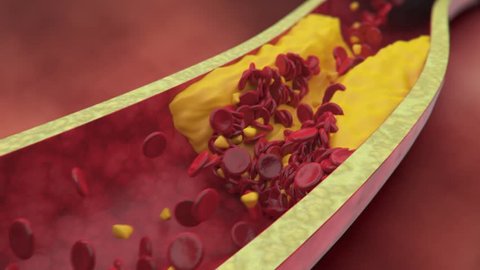 Plaque clogged artery. Digital animation.