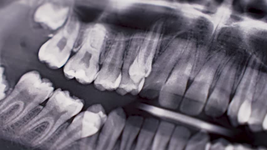 Dental X-ray scan of teeth, close-up. Panoramic dental x-ray