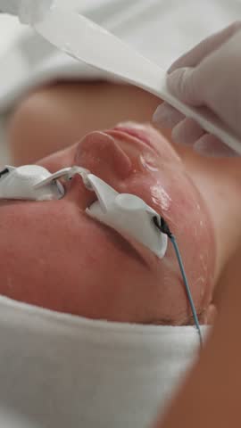 The cosmetologist applies the cream to the patient's face. The procedure for cleaning the skin from pigment spots and couperosis, against wrinkles. High quality 4k footage