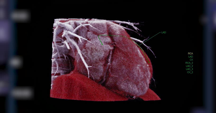 Realistic 3D Heart CTA Scan Footage:
A detailed CTA scan showing the coronary arteries and heart structure, providing a comprehensive view for clinical evaluation.