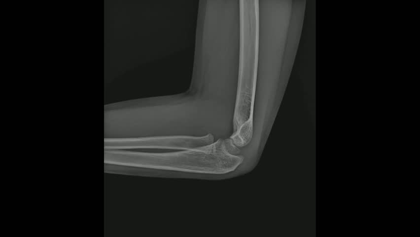 Lateral View of Elbow Joint X-Ray - Medical Imaging for Orthopedic Assessment