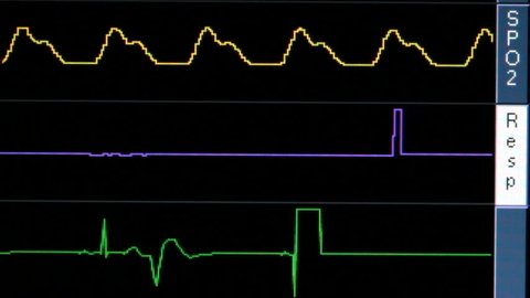 Wavy lines on vital signs monitor, close up, flatline as patient dies. 1080p