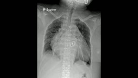 Digital Chest X-Ray AP View for Essential Chest Radiograph Imaging - Powered by Shutterstock - Get 15% off with code: PIKWIZARD15