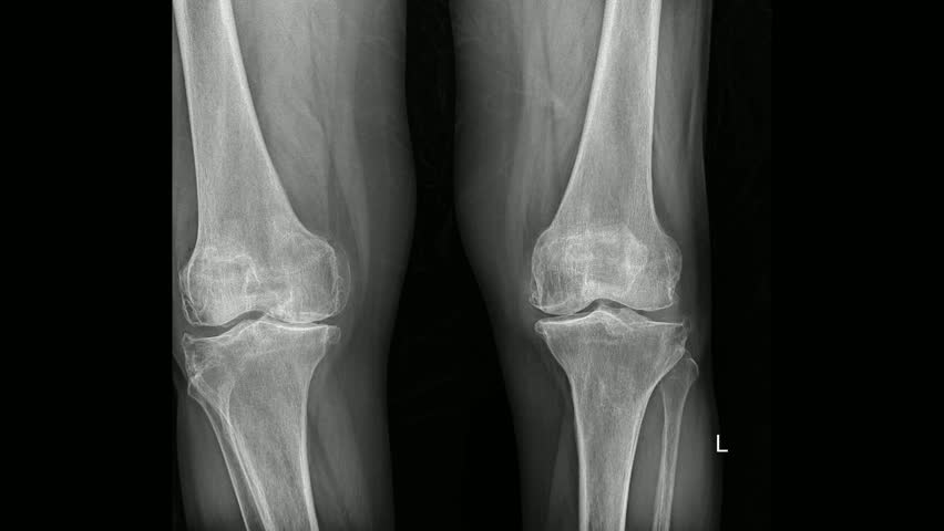 x-ray image of both knee AP view for detect Osteoarthritis Knee or OA Knee .