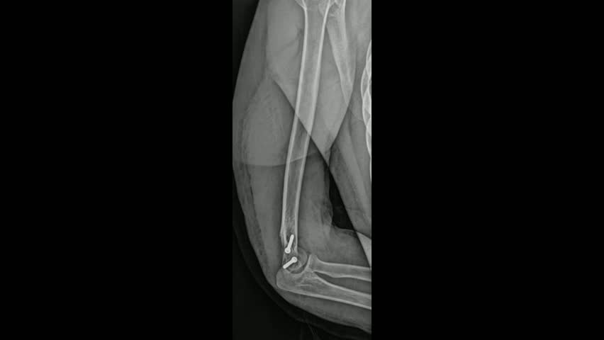 Humerus and Elbow X-ray of Patient