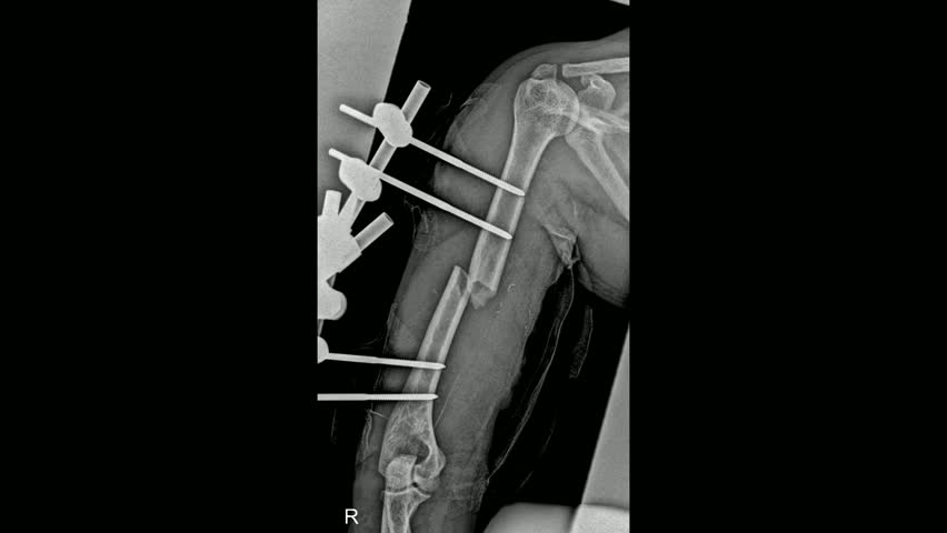Post-Operative X-Ray of Humeral Shaft Fracture with External Fixation for Bone Healing Assessment