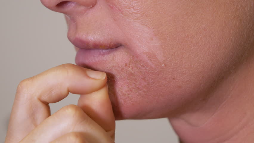 CLOSE UP, DOF: Scratching and peeling of dead and dry facial skin after sunburn. Young woman was overdoing her tanning under the strong summer sun and suffered severe and harmful burns on her face.