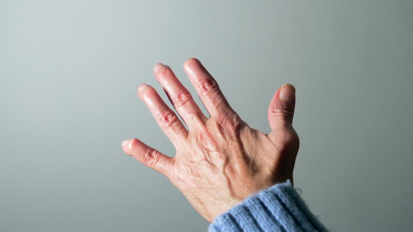 Elderly woman's severely deformed hand exposing painful rheumatoid arthritis symptoms affecting joint mobility with visible finger structural changes