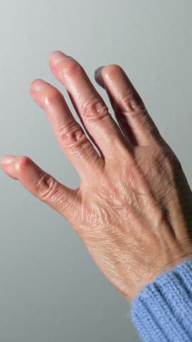Rheumatoid arthritis causing visible hand deformation, showcasing joint inflammation and mobility challenges affecting elderly woman's fingers