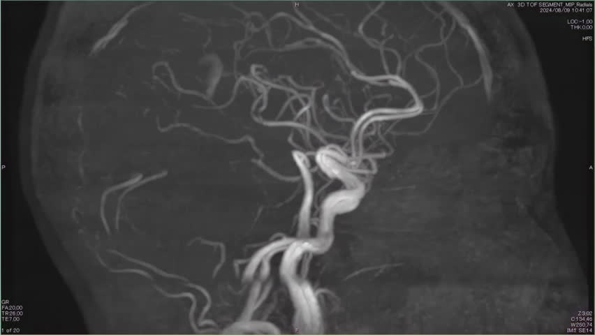 Magnetic resonance images of the brain, MRI of the brain, of a patient with multiple vascular infarctions, Contrast study of cerebral vessels, animation Seamless Loop