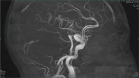 Magnetic resonance images of the brain, MRI of the brain, of a patient with multiple vascular infarctions, Contrast study of cerebral vessels, animation Seamless Loop - Powered by Shutterstock - Get 15% off with code: PIKWIZARD15