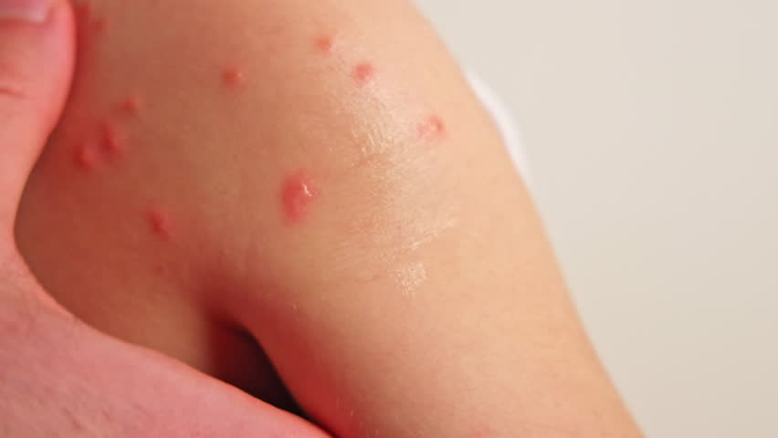 adorable baby boy with lot of insects bites on shoulder isolated on clean backdrop. cute kid child with many red bumps and doctor or father dad hand applying treatment gel.close up, space for text