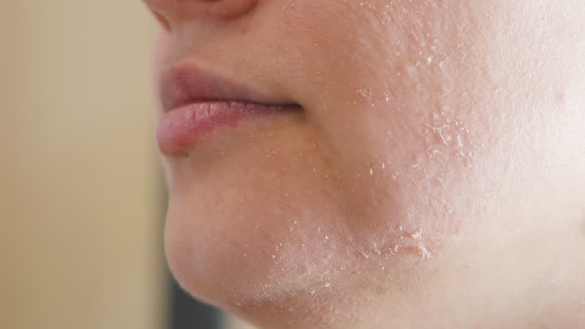 Close up capturing woman gently touching dry, irritated facial skin, highlighting sensitive dermatological skincare texture and complexion issue