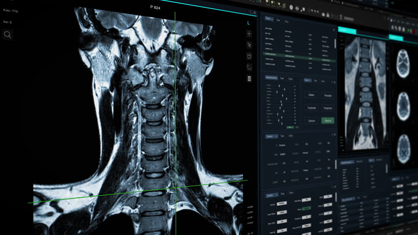 Modern Cancer Research Medical Neurology Software with MRI Screening Process: Computer Monitor Image with 3D Application Visualizing Human Neck and Spine on a Digital CT Scan