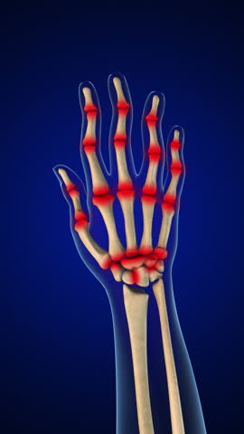From Mild to Severe Hand Arthritis