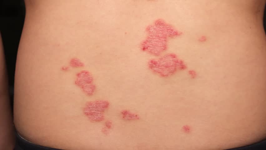 Red patches and peeling skin are visible on the torso, showcasing the effects of psoriasis. The chronic inflammation can cause discomfort.