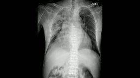Medical Imaging: High-Quality Supine Chest X-Ray Footage - Powered by Shutterstock - Get 15% off with code: PIKWIZARD15