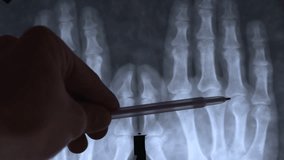 Doctor learning X-Ray Image of Human hands bones. Skeletal structure for medical analysis of osteoarthritis, muscular dystrophy and stroke. Inflammation of the joints on the hands. - Powered by Shutterstock - Get 15% off with code: PIKWIZARD15